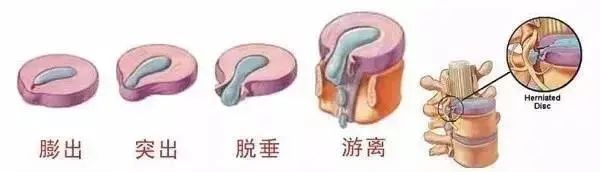 中医经络微创疗法_腰椎间盘突出中医治疗_乡村医生腰腿疼论坛