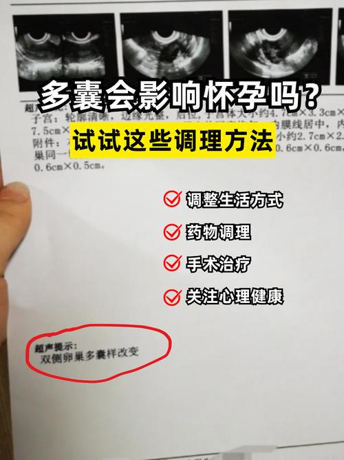 多囊卵巢综合征症状和影响_多囊卵巢综合征误解_多囊卵巢都检查什么